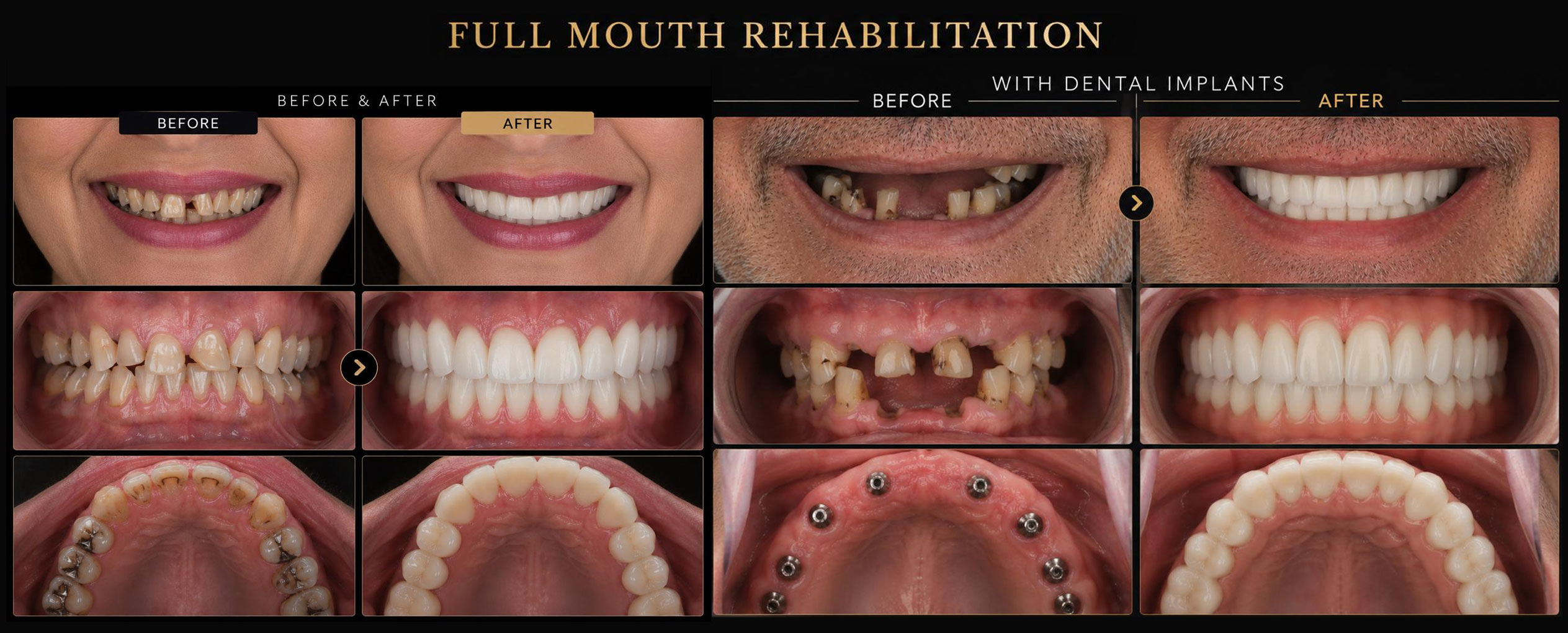 Full mouth rehabilitation Bangalore