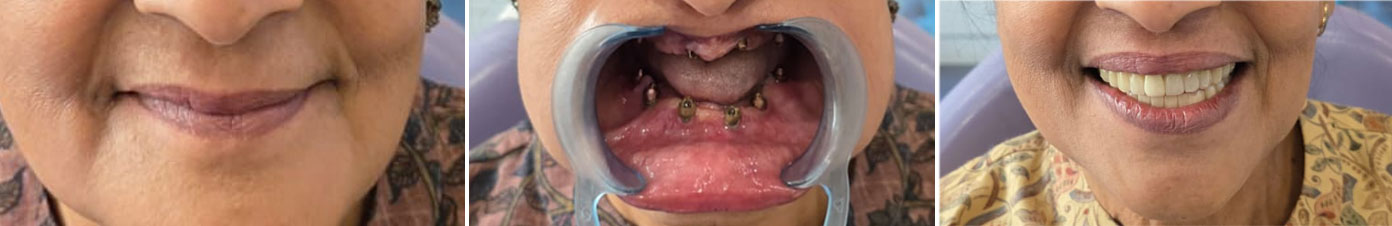 Full mouth rehabilitation in Bangalore