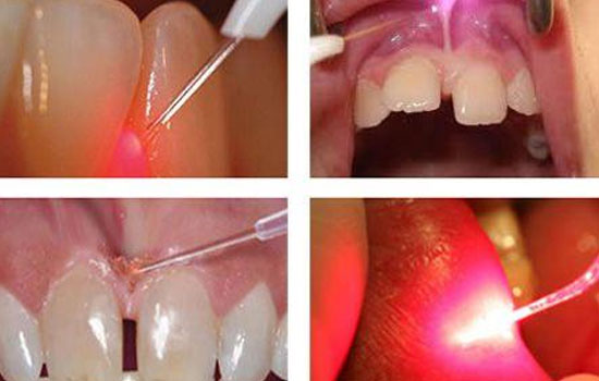 Advanced Gum treatment Bangalore