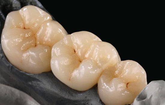 Dental Crowns & Veneers in Bangalore
