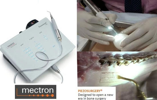 Wisdom tooth removal Bangalore