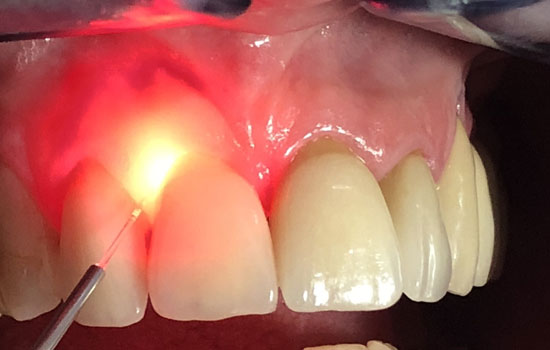 Wisdom tooth removal Bangalore