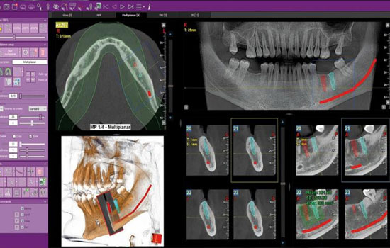 Dental Crowns & Veneers in Bangalore