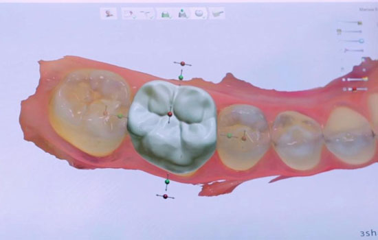 Dental Crowns & Veneers in Bangalore